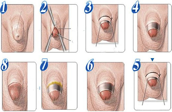 Cắt bao quy đầu bao nhiêu tiền?