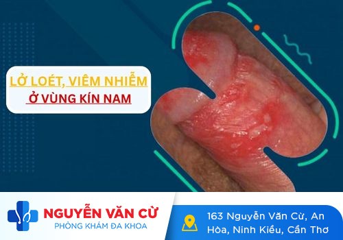 Viêm vùng kín ở nam và cách điều trị hiệu quả