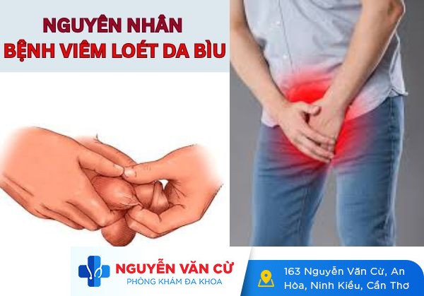 Viêm loét da bìu ở nam giới có thể trị dứt điểm không ?