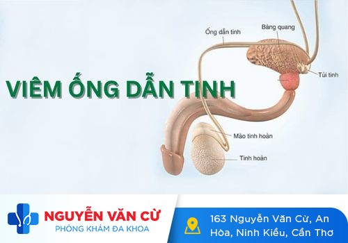 Viêm ống dẫn tĩnh – nguyên nhân và cách điều trị