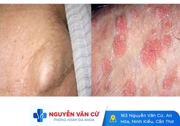 Dương vật nổi hạch – Nguyên nhân và cách điều trị hiệu quả