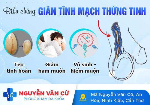 Giãn tĩnh mạch thừng tinh: Nguyên nhân và cách điều trị