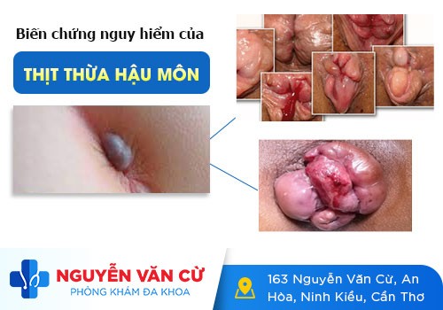 Thịt Dư Thừa Ở Hậu Môn Có Phải Bệnh Sùi Mào Gà Không?