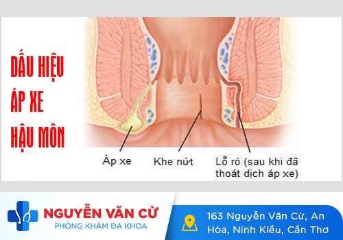 Chi Phí Chữa Áp Xe Hậu Môn Hết Bao Nhiêu Tiền?