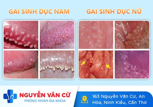 Gai Sinh Dục Thường Mọc Ở Đâu Trên Cơ Thể?