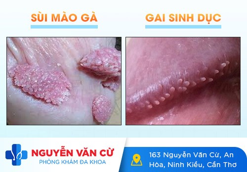 Bảng Phân Biệt Sùi Mào Gà Và Gai Sinh Dục Có Hình Ảnh Minh Họa