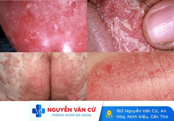 Nguyên nhân gây bong da dương vật và cách điều trị