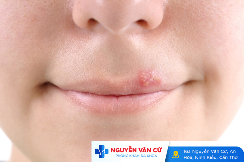 Mụn Nước Ở Miệng Đừng Chủ Quan – Xem Bài Sau Sẽ Rõ