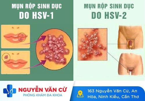 HSV Là Bệnh Gì Có Điều Trị Được Không?