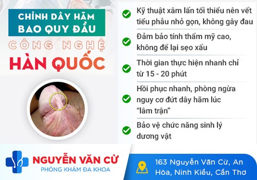 Dây Hãm Bao Quy Đầu Ngắn Phải Làm Sao?