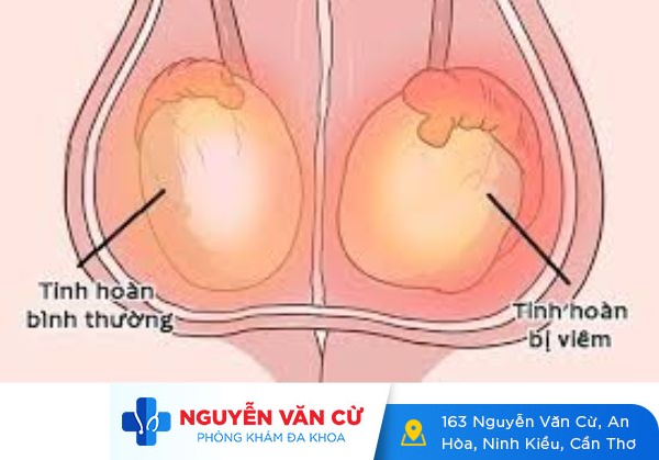 Nguyên nhân viêm tinh hoàn phái mạnh không nên bỏ qua