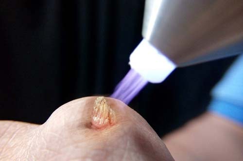 Bắn Laser Trị Sùi Mào Gà Có Hiệu Quả Không