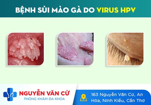 Cách Phân Biệt Mun Rộp Sinh Dục Và Sùi Mào Gà Dễ Dàng