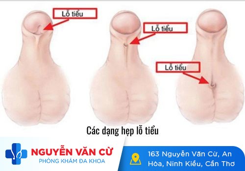 Thông tin xung quanh vấn đề hẹp lỗ tiểu