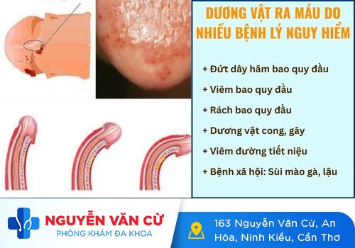 [Giải Đáp Thắc Mắc]: Dương vật ra máu là bị bệnh gì?