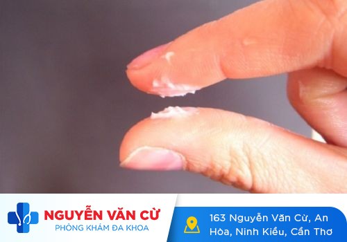 Ra huyết trắng vón cục có sao không?