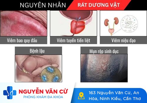 Rát dương vật ở nam giới là dấu hiệu bệnh gì?
