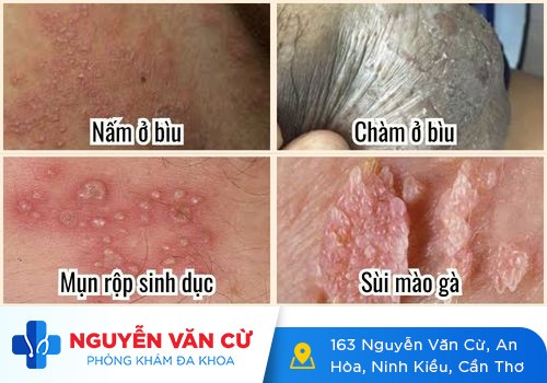 Ngứa bìu tinh hoàn – bệnh tưởng đơn giản nhưng khó điều trị