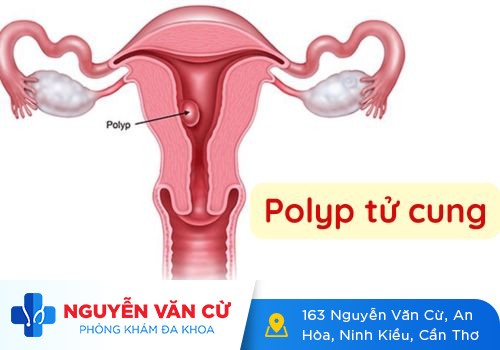 Polyp Cổ Tử Cung Là Bệnh Gì?
