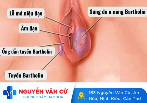 U cục sưng cứng gần âm đạo – Triệu chứng của viêm tuyến bartholin