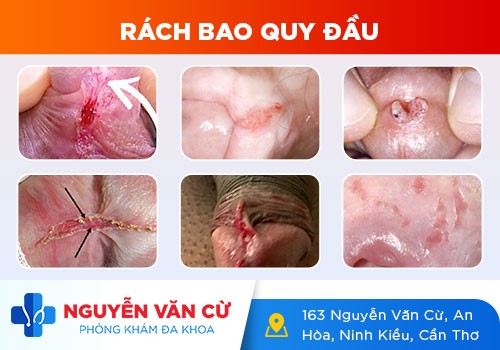 Tình trạng rách bao quy đầu ở nam giới