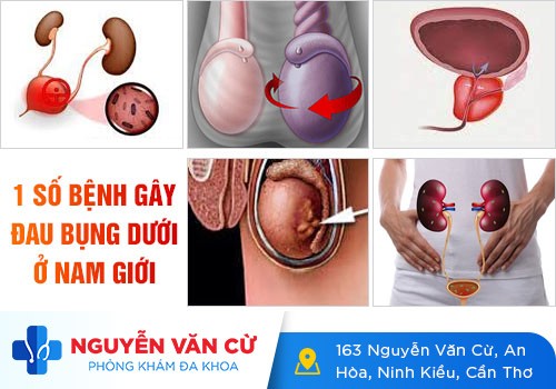 Không nên chủ quan với tình trạng đau bụng dưới ở nam