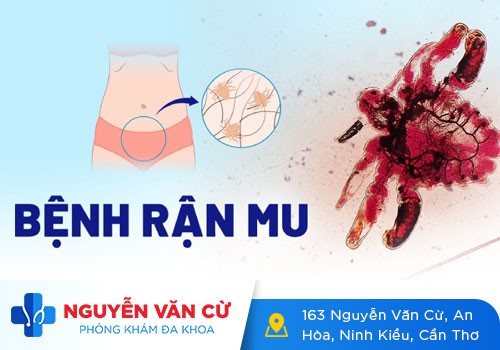 Rận mu – Bệnh nguy hiểm, đừng chủ quan