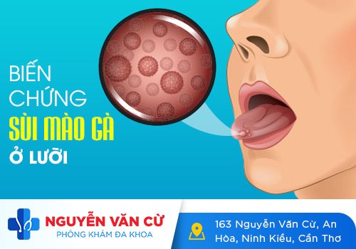 Cách Điều Trị Khi Bị Mọc Mụn Thịt Ở Cuống Lưỡi Triệt Để