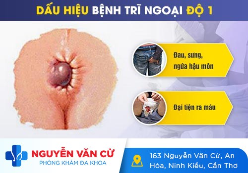 Bệnh trĩ ngoại độ 1, độ 2: Cần chữa ngay để tránh biến chứng
