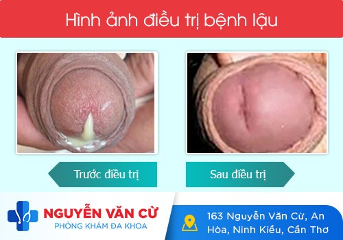 Giọt Sương Ban Mai Là Gì Có Phải Bệnh Lậu Không?