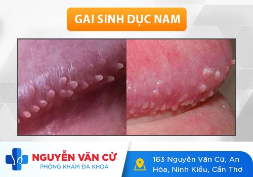 Bệnh Gai Sinh Dục Có Nguy Hiểm Không?