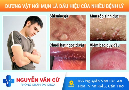 Mụn Thịt Ở Dương Vật Là Dấu Hiệu Của Bệnh Gì?