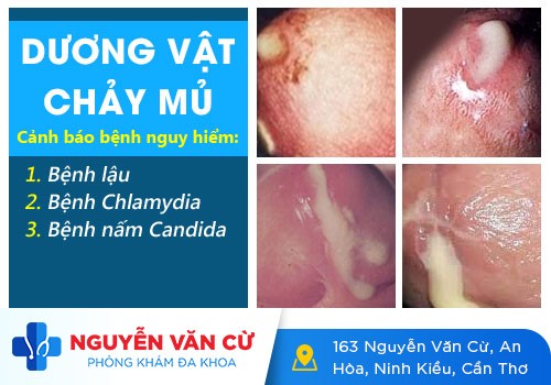 Dương Vật Ra Mủ Là Bệnh Gì? – Nguyên Nhân Và Cách Điều Trị Hiệu Quả Nhất