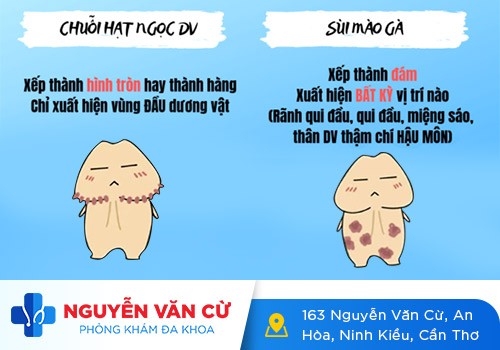 Hạt ngọc dương vật có phải sùi mào gà không?