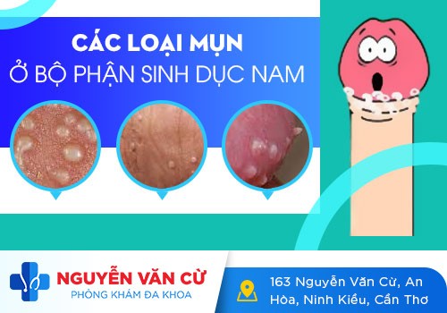 Nổi Mụn Trắng Ở Bìu Tinh Hoàn: Hình Ảnh Và Cách Khắc Phục