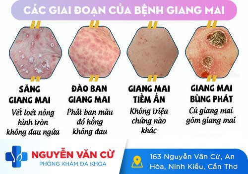 Bệnh Giang Mai Và Những Thông Tin Cần Biết
