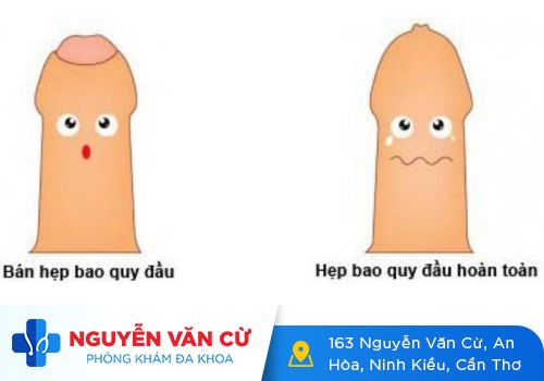 Không nên chủ quan với chứng hẹp bao quy đầu