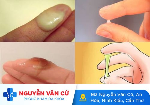 Thận trọng khi huyết trắng có màu, mùi hôi và ngứa 