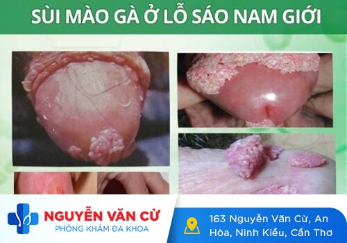 Sùi Mào Gà Ở Lỗ Sáo: Hình Ảnh, Nguyên Nhân, Dấu Hiệu Và Cách Trị