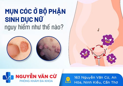 Những Điều Cần Biết Về Mụn Cóc Ở Vùng Kín