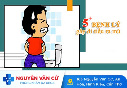 Đi Tiểu Ra Dịch Nhầy Chất Nhờn Là Dấu Hiệu Bệnh Gì?