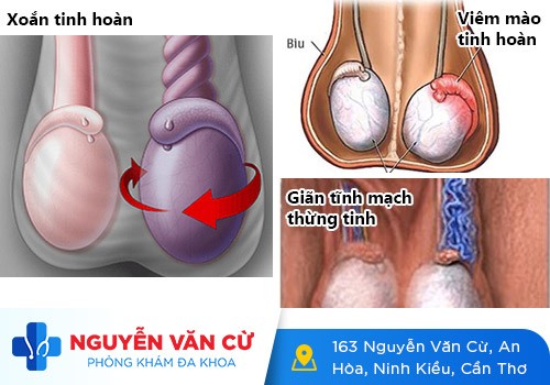 Bệnh tinh hoàn – Nỗi sợ của đàn ông