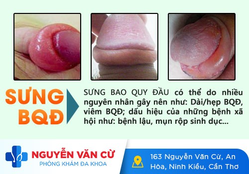 Sưng bao quy đầu là bị bệnh gì? Có nguy hiểm không?
