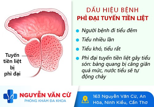 Nguyên nhân tiểu lắt nhắt, tiểu không hết