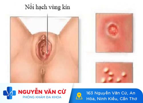 Vì sao không ai nói về nổi hạch ở vùng kín nữ có sao không?