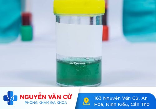 Nước tiểu có màu lạ – dấu hiệu của nhiều bệnh lý nguy hiểm