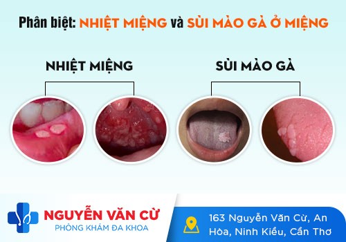 Nổi Hột Đỏ Ở Cuống Lưỡi Là Bệnh Gì? Cách Điều Trị Như Thế Nào?