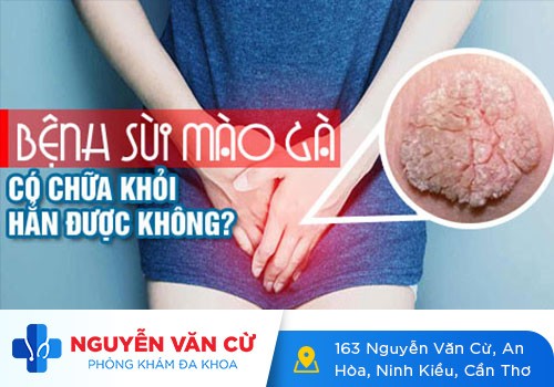 Bệnh Sùi Mào Gà Có Chữa Trị Khỏi Được Không?