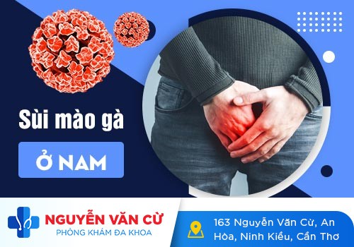 Triệu chứng của bệnh sùi mào gà ở nam là như thế nào?