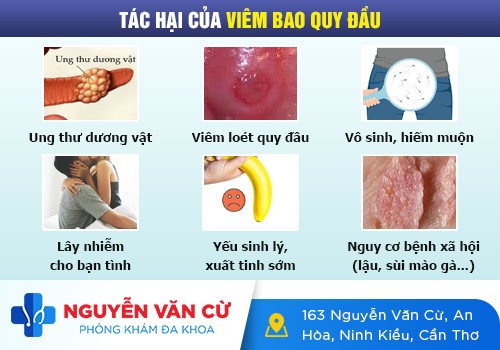 Phương Pháp Điều Trị Viêm Bao Quy Đầu An Toàn – Hiệu Quả Cao